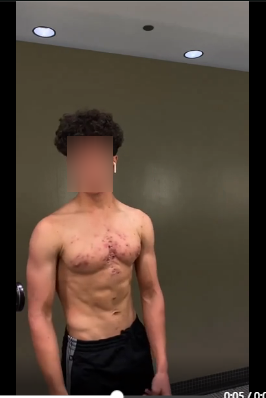 16 year old on steroid